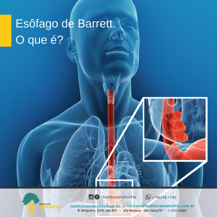 Es Fago De Barrett O Que Instituto Endovitta