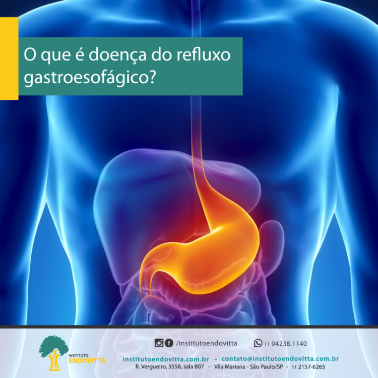 O Que Doen A Do Refluxo Gastroesof Gico Drge Instituto Endovitta