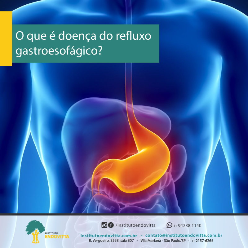 O Que é Doença Do Refluxo Gastroesofágico Drge Instituto Endovitta
