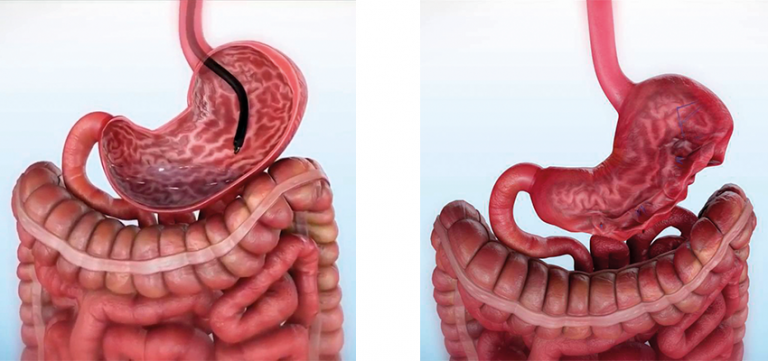 Gastroplastia EndoscÓpica Instituto Endovitta 